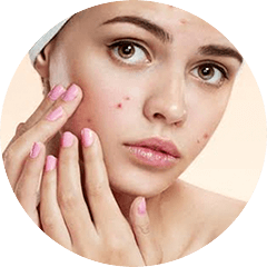 Acne - Problems with Oily Skin