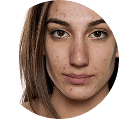 Pimples - Problems with Oily Skin