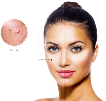 Causes of Pimples